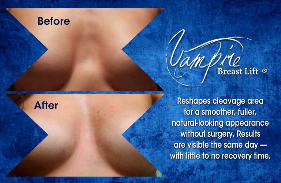 Maintain The Results Of Breast Lift Surgery